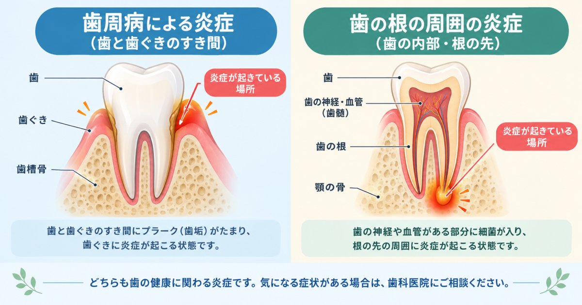歯ぐきから膿が出る主な2つの仕組み